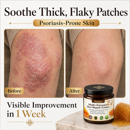 ✨HISKIN® Multi-Concern Skin Repair Cream ✨ (One powerful cream to repair inflammation, dryness, aging, pigmentation, and visible skin damage.)